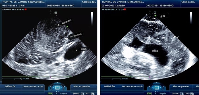 左圖顯示術中超聲見囊實性病變，大小約為4x4x3cm，病灶周圍腦組織水腫明顯；右圖為病灶切除后，術中超聲示術腔無病變殘留
