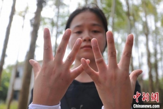 吳素英展示被蜜蜂蜇過的雙手。湯曉逵 攝