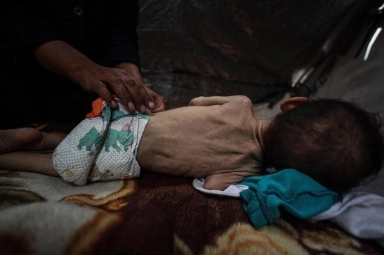 這是5月28日在加沙城西部一處臨時安置點拍攝的一名營養(yǎng)不良的嬰兒。新華社發(fā)（馬哈茂德·扎基攝）